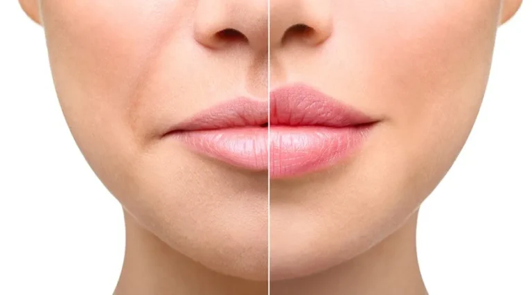 Split image of a woman's lower face highlighting differences. Left side shows wrinkles and dull lips; right side is smooth with fuller, pink lips.