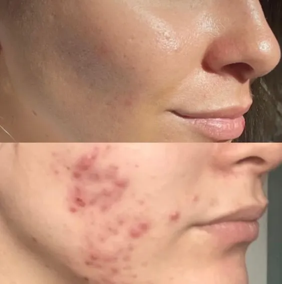 Side-by-side comparison of a cheek. The top image shows clear skin, while the bottom image shows acne with red blemishes. Conveys skin improvement.