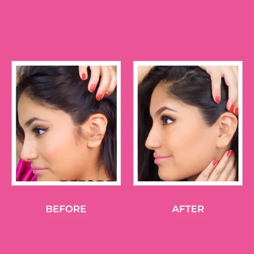 A side-by-side comparison shows a woman's face before and after an ear pinning procedure. The background is bright pink, and she's smiling gently.
