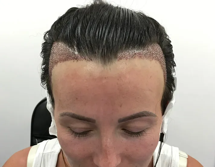Woman with dark hair reveals recent hair transplant procedure on her forehead. The scalp shows new grafts, conveying a clinical, hopeful tone.