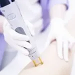 A person wearing gloves uses a laser device on another person's leg, suggesting a cosmetic or medical procedure. The setting is clinical and professional.