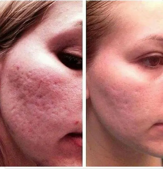 Close-up of a woman's cheek showing skin improvement. Left: acne scars and redness. Right: smoother, clearer skin. Emphasizes skincare results.