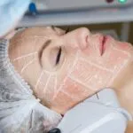 A woman receiving a facial treatment with a patterned grid on her cheek. She wears a hair cap, looking relaxed and calm during the procedure.